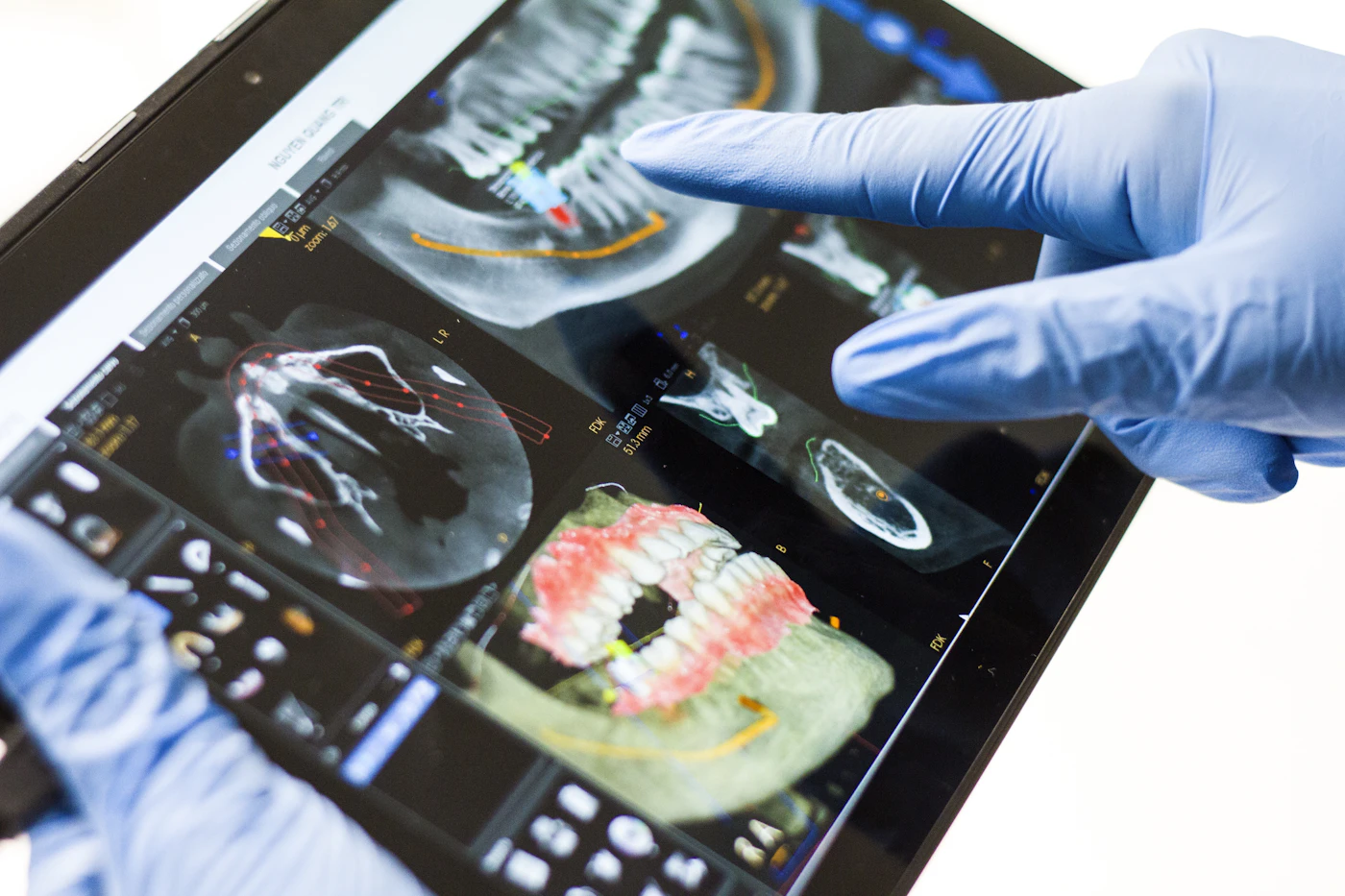 A gloved hand pointing at a dental scan on a tablet